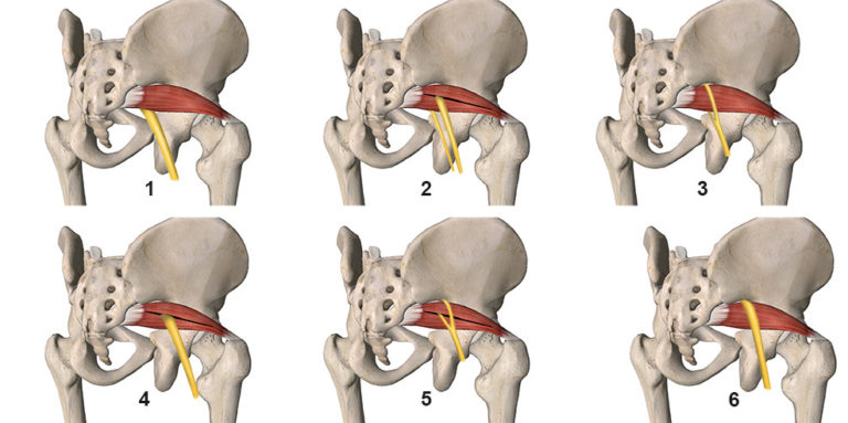 Piriformis Syndrome Causes